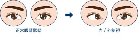 眼睛斜視|眼睛：斜視的成因、預防及治療